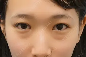 before image