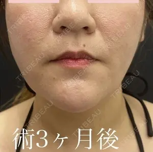 90 days after image