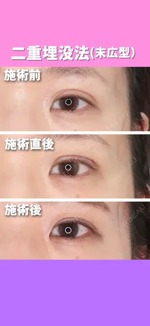 before image