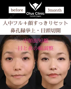 90 days after image