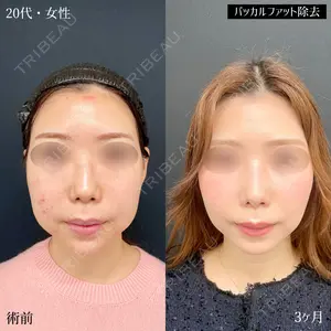 90 days after image