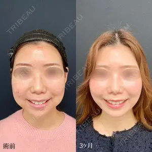 90 days after image