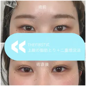 before image