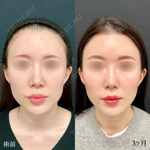 90 days after image