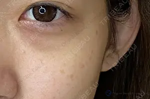 before image