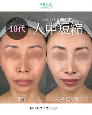 90 days after image