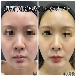 90 days after image