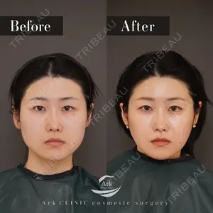 90 days after image