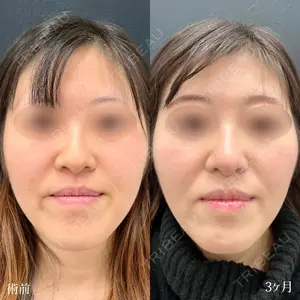 90 days after image