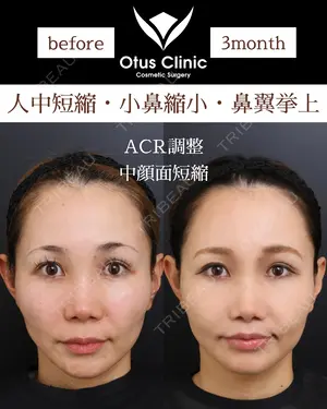90 days after image