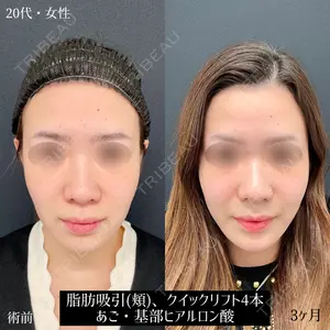 90 days after image