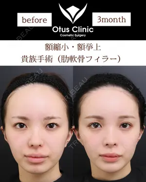 90 days after image