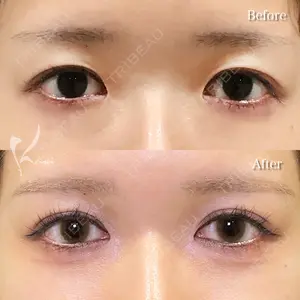 before image