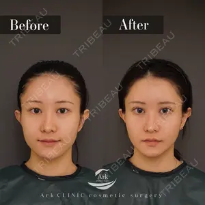 90 days after image