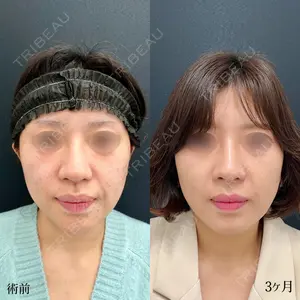 90 days after image