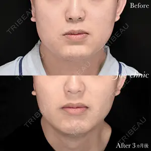 90 days after image