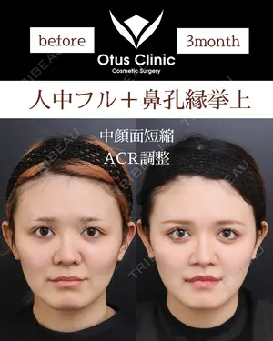 90 days after image