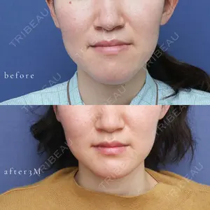 90 days after image