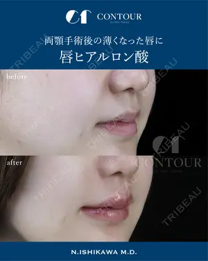 0 days after image