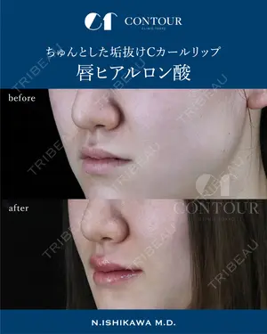 before image