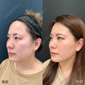 90 days after image