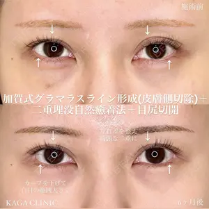 before image