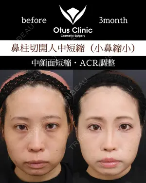 90 days after image