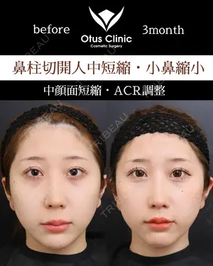 90 days after image