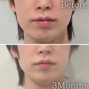 90 days after image