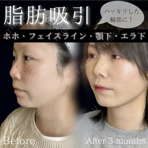 90 days after image