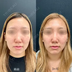 90 days after image