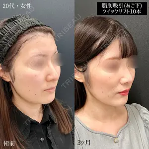 90 days after image