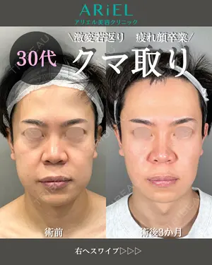 90 days after image