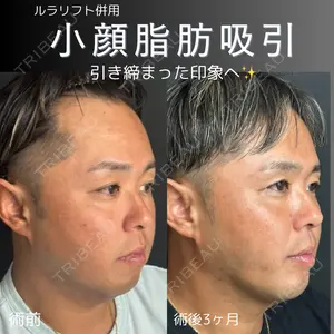 90 days after image