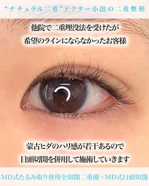 before image