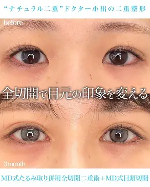 90 days after image