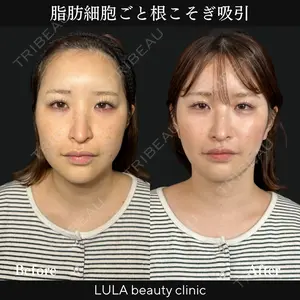 before image