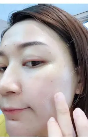 0 days after image