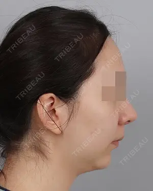before image