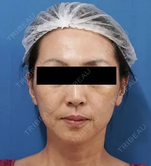 before image