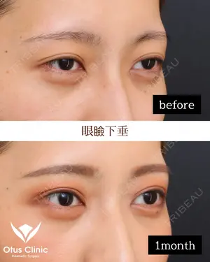 30 days after image