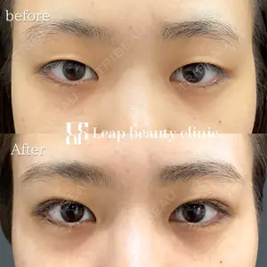 before image