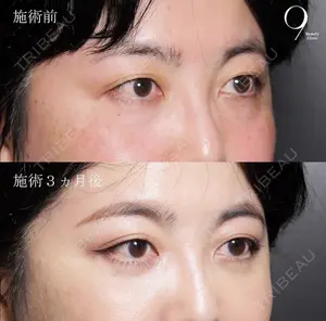 before image