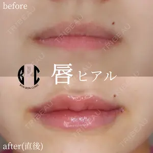 before image