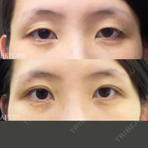 before image