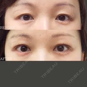 before image