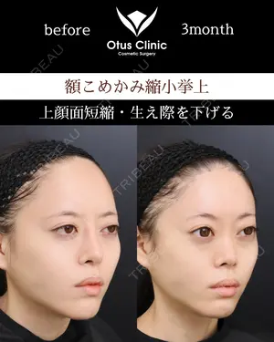 90 days after image