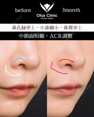 90 days after image
