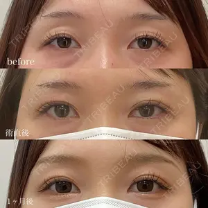 before image