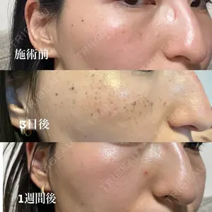 7 days after image